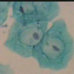 Γιγαντιοκύτταρα με κοιλοκυττάρσωη - έρπης